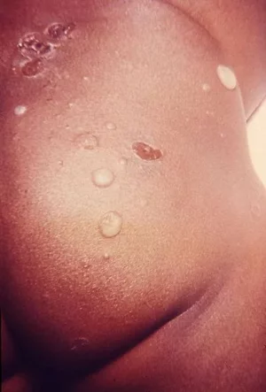 520px-Impetigo.webp