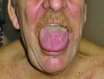 588-macroglossia-s182-springer-high_fr.webp