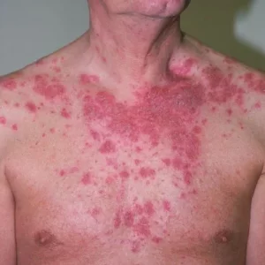 pemphigus-foliaceus-5-6a-mckoy-sized_fr.webp