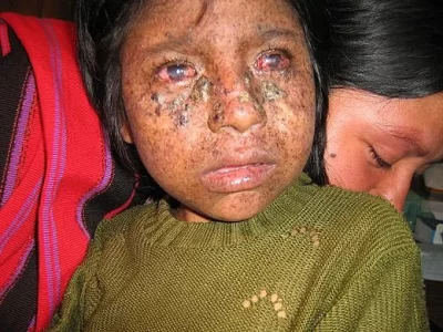 520px-Xeroderma_pigmentosum_02.webp