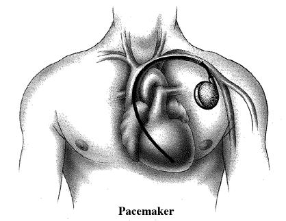 pacemaker.jpg