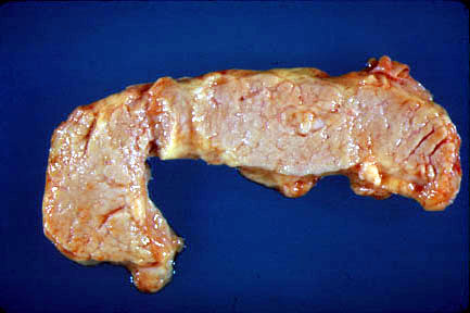 normal_pancreas.jpg